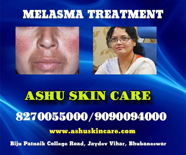 best melasma treatment clinic in bhubaneswar near me - dr anita rath